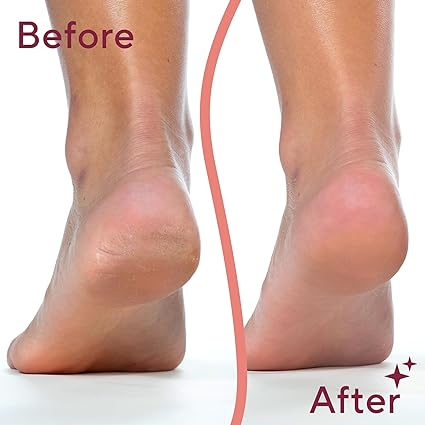 Souqzila electric pedicure foot file before and after heels comparison showing rough cracked heel to smooth heel